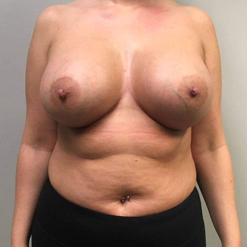 Breast Augmentation 127