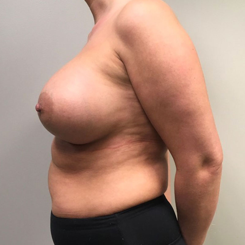 Breast Augmentation 07