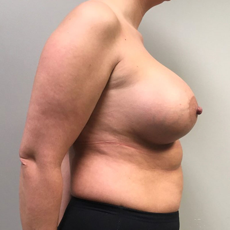 Breast Augmentation 09