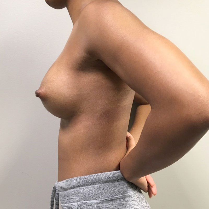 Breast Augmentation 03
