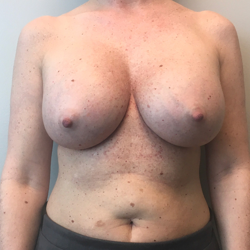 Breast Augmentation 130