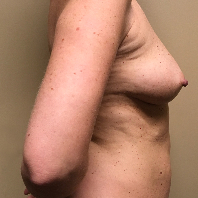 Breast Augmentation 05