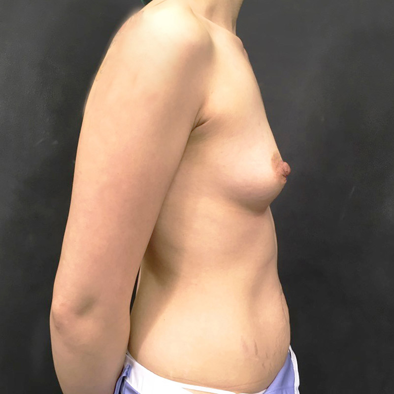 Breast Augmentation 07
