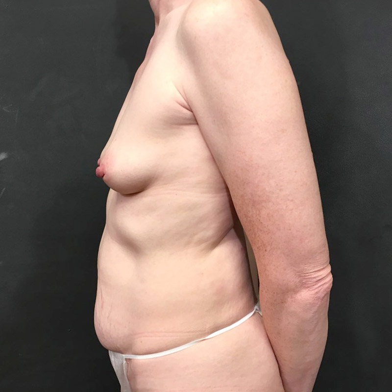 Breast Augmentation 07