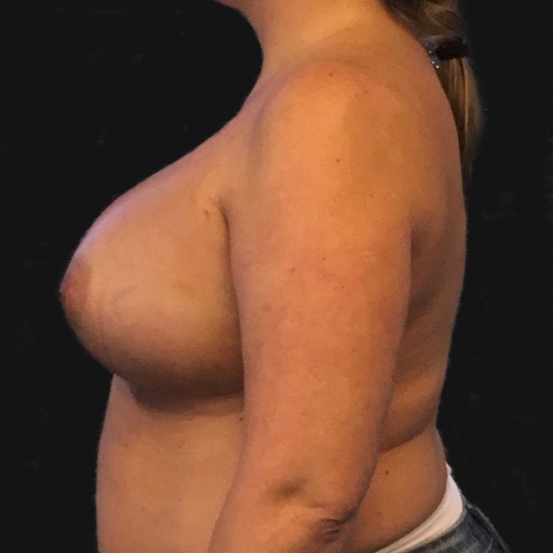 Breast Augmentation 05
