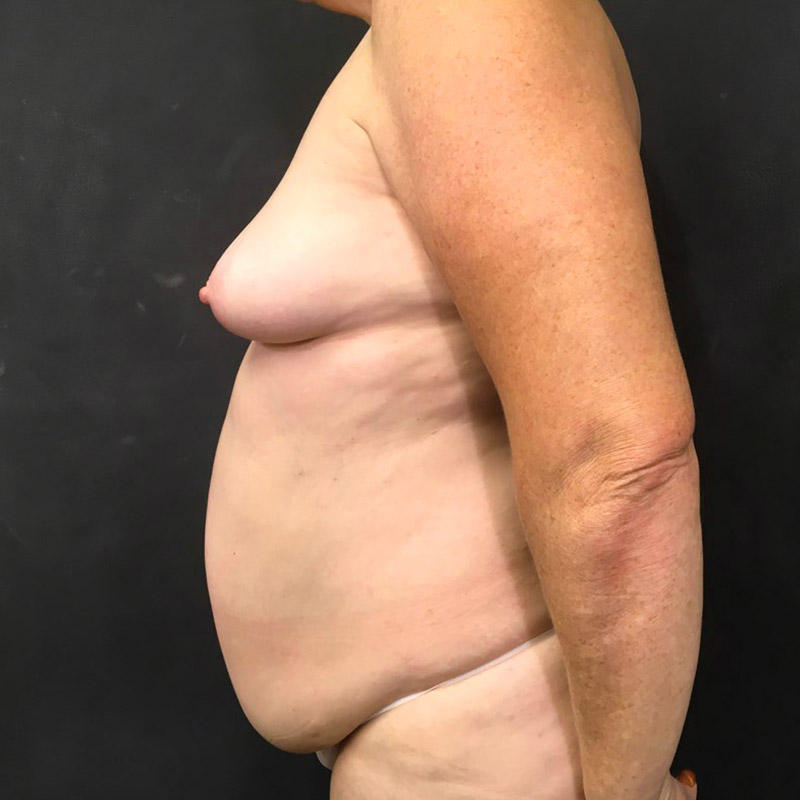 Breast Augmentation 03