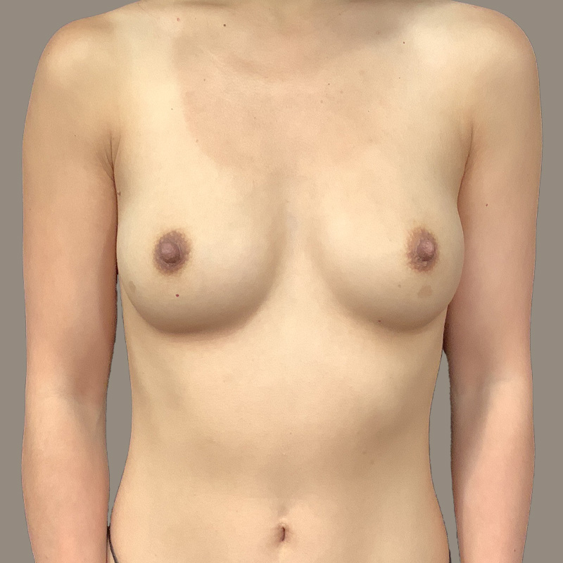 Breast Augmentation 01