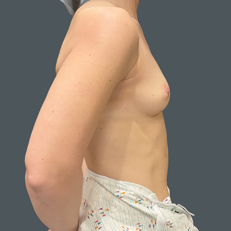Breast Augmentation 05