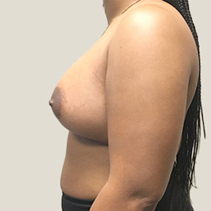 Breast Augmentation 05