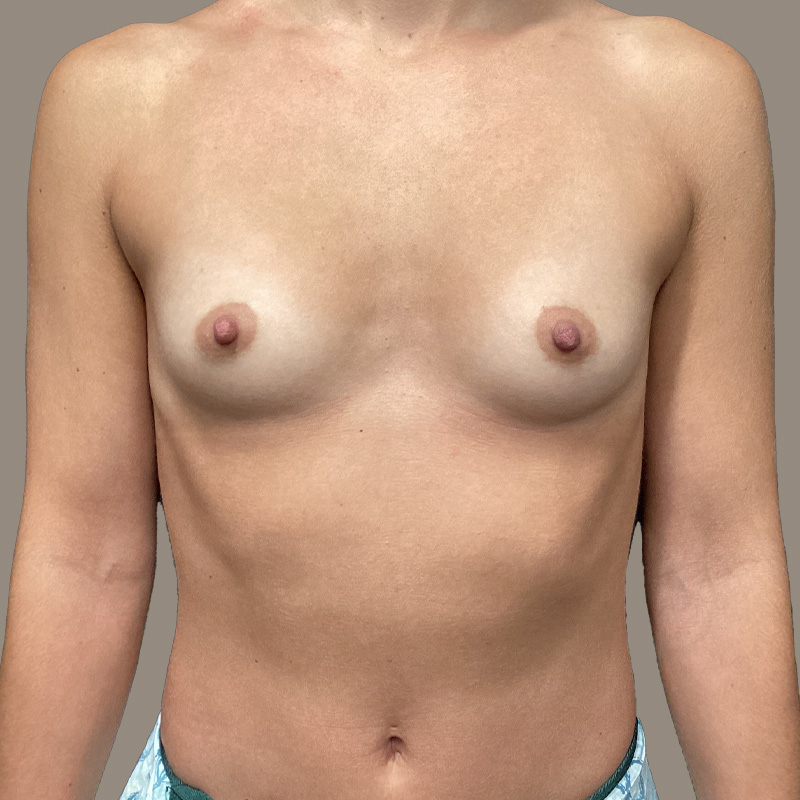 Breast Augmentation 01
