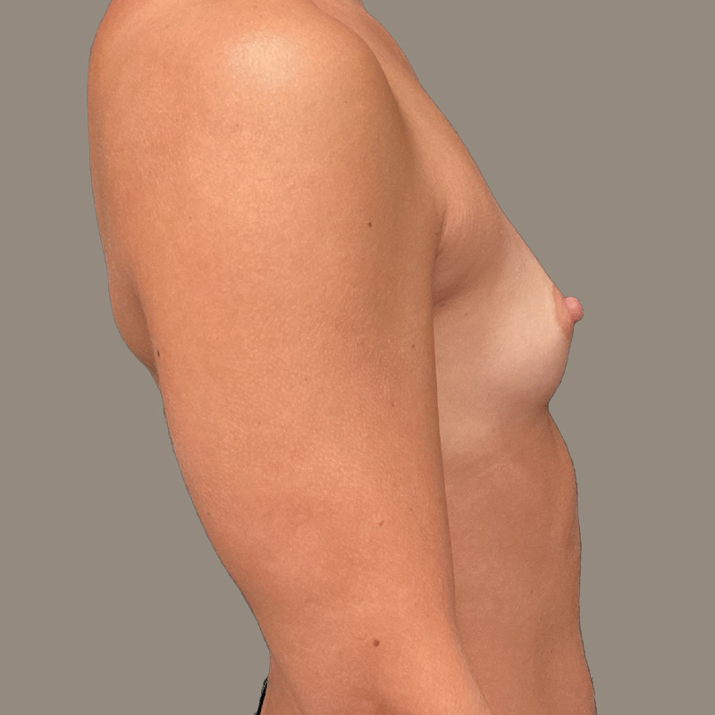 Breast Augmentation 03