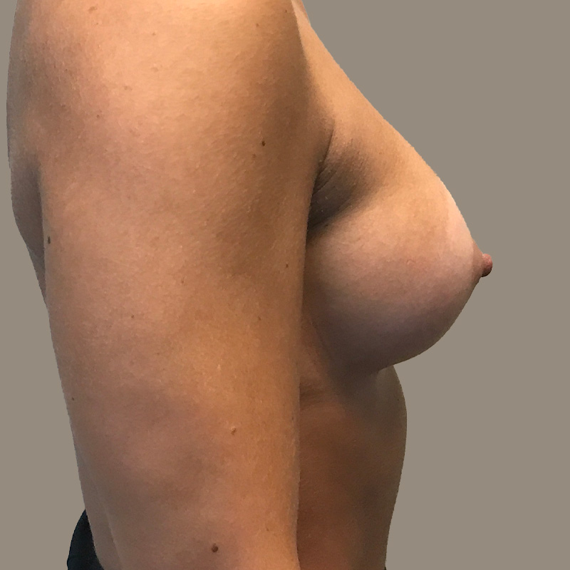 Breast Augmentation 03