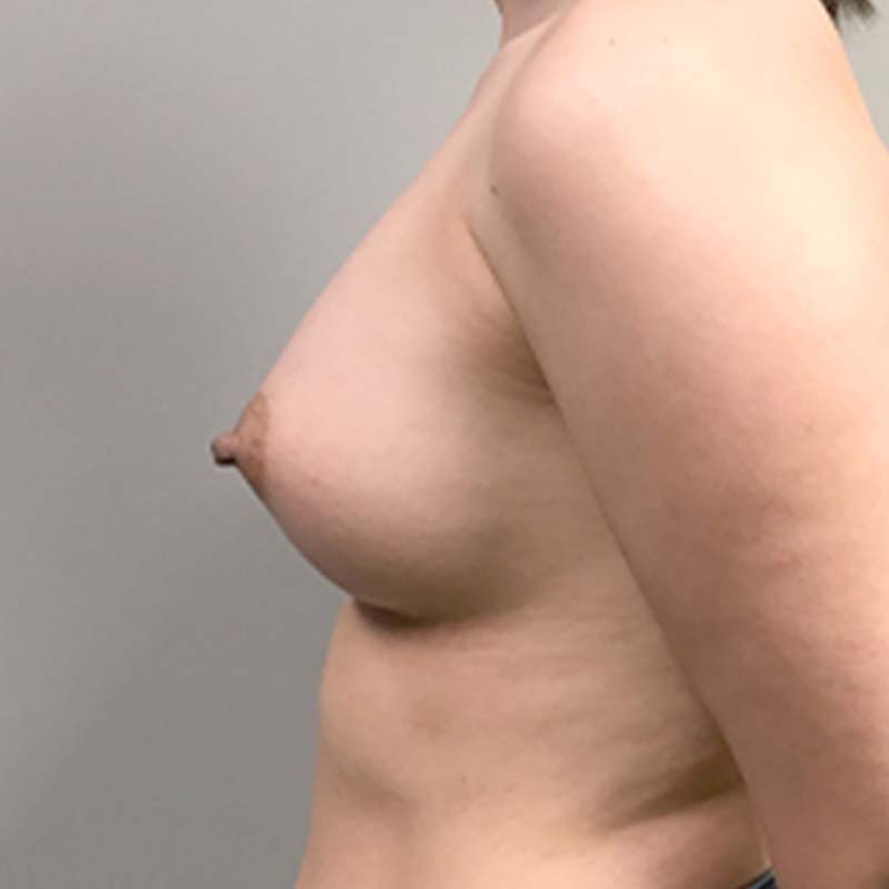 Breast Augmentation 05