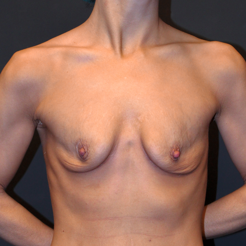 Breast Augmentation 01