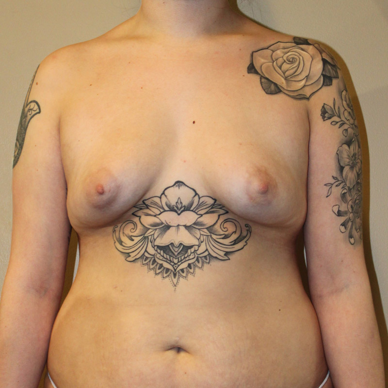 Breast Augmentation 01