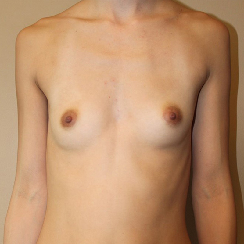 Breast Augmentation 01