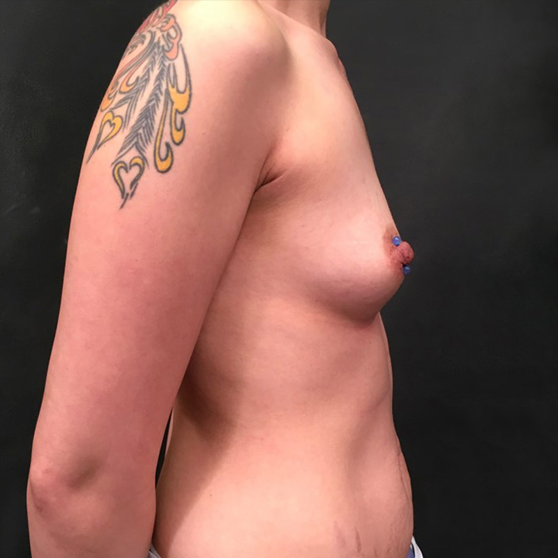 Breast Augmentation 05