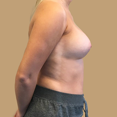Breast Augmentation 07