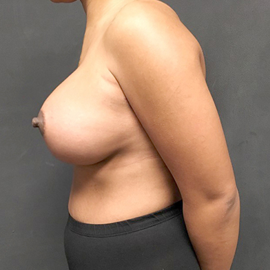 Breast Augmentation 03
