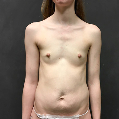 Breast Augmentation 01
