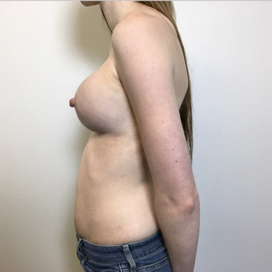 Breast Augmentation 03