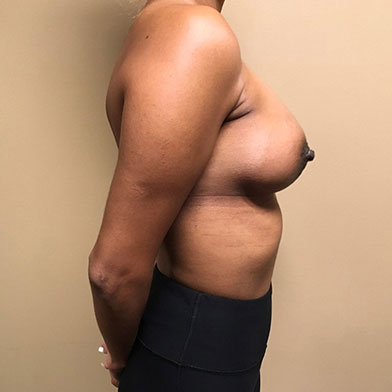 Breast Augmentation 07