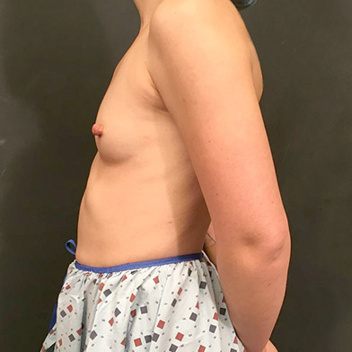 Breast Augmentation 05