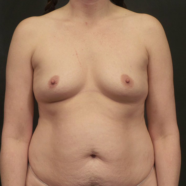 Breast Augmentation 01