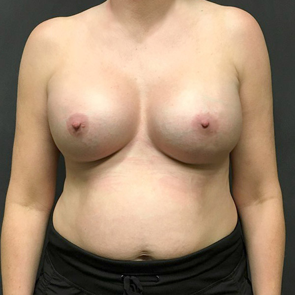 Breast Augmentation 53