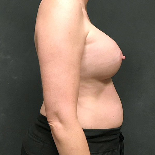 Breast Augmentation 07