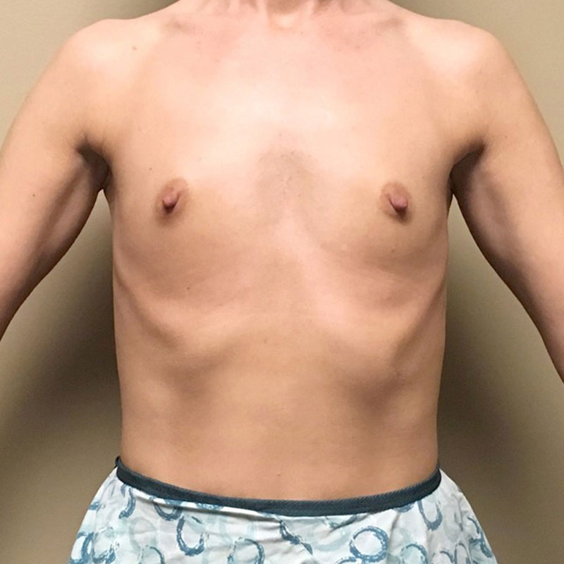 Breast Augmentation 01