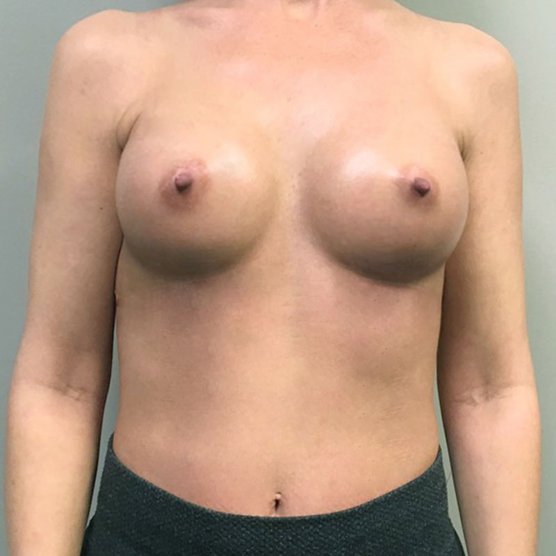 Breast Augmentation 57