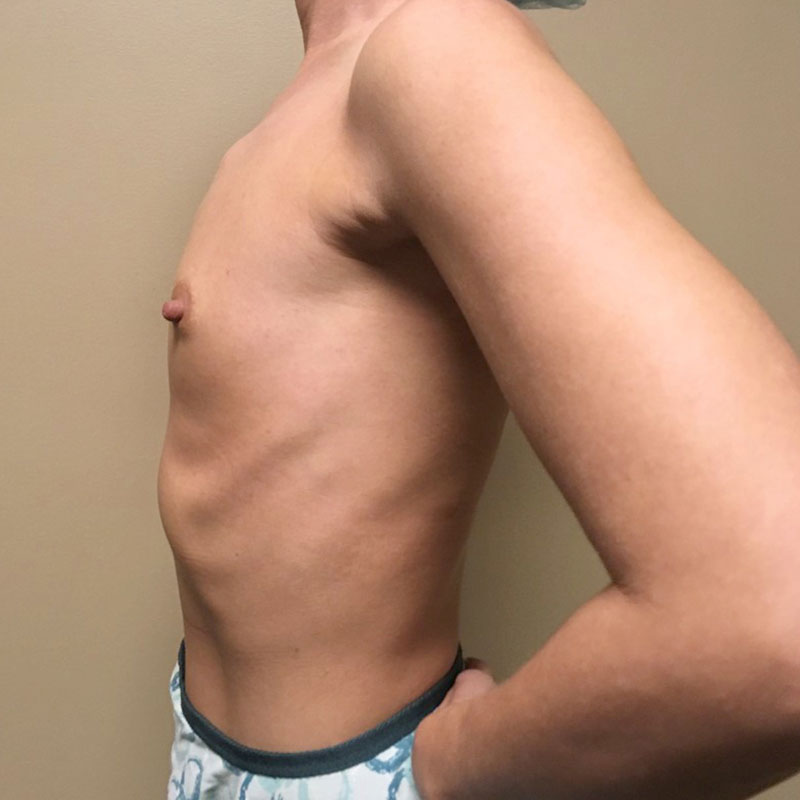 Breast Augmentation 05