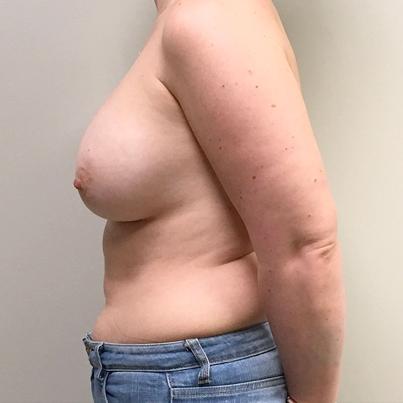 Breast Augmentation 05