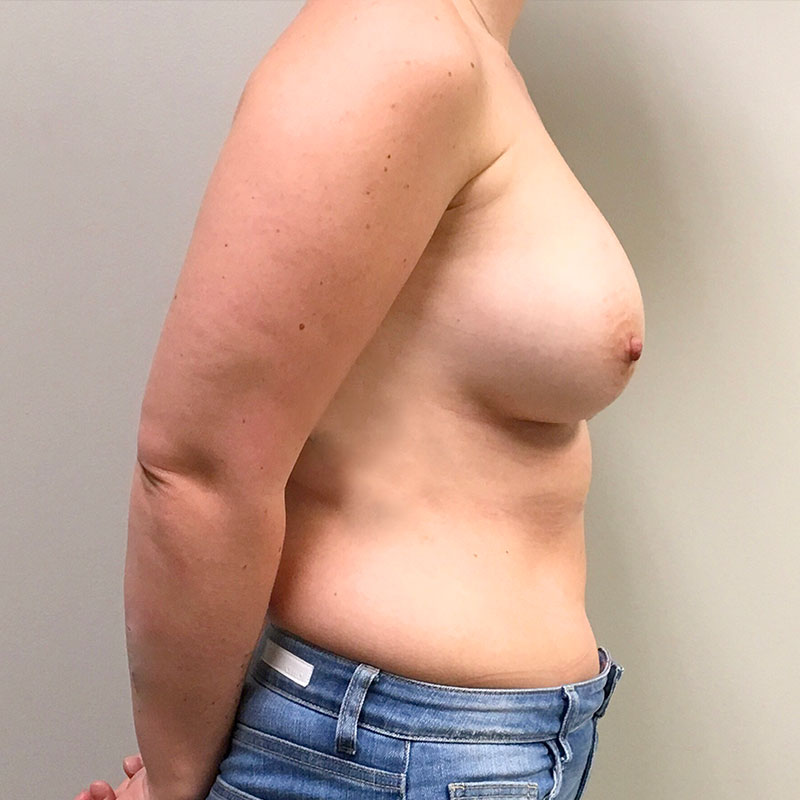 Breast Augmentation 09
