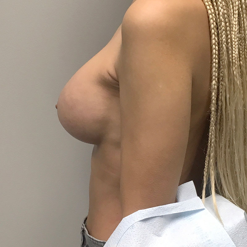 Breast Augmentation 05
