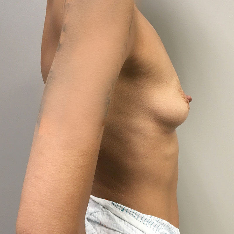 Breast Augmentation 09