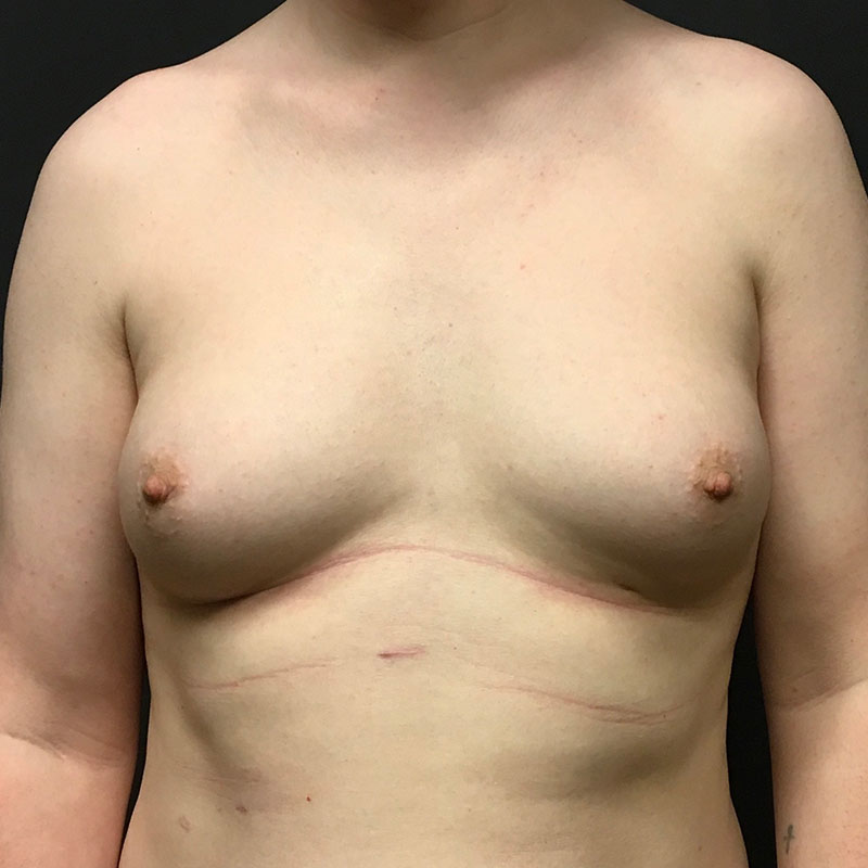 Breast Augmentation 01
