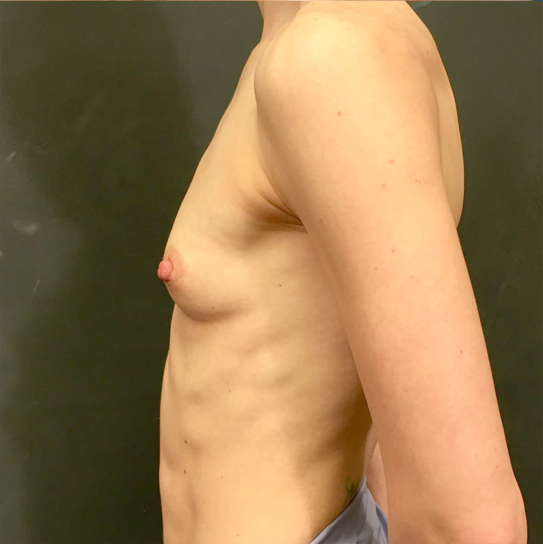 Breast Augmentation 03