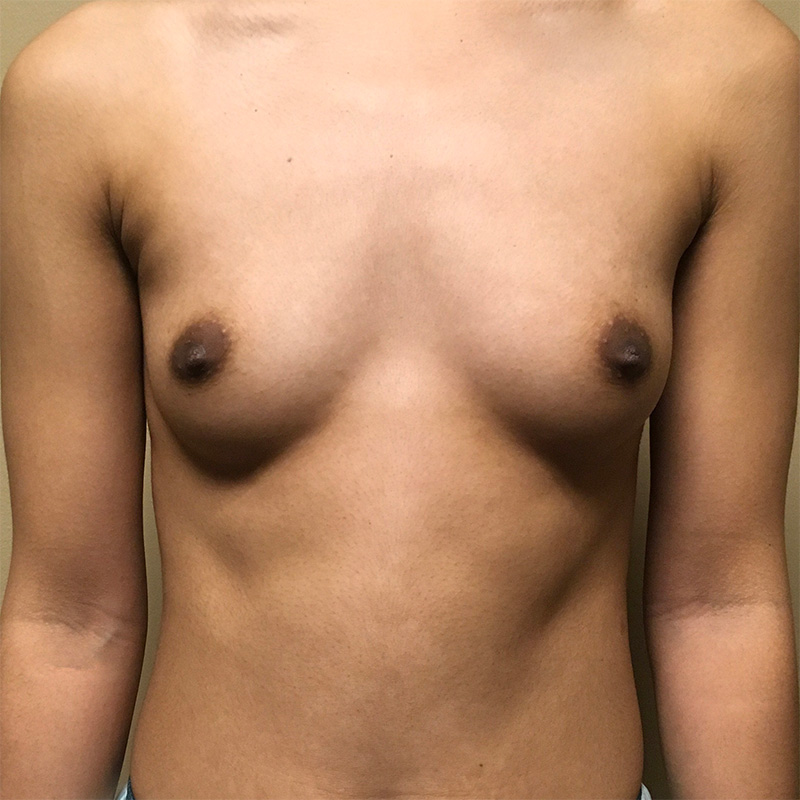 Breast Augmentation 01