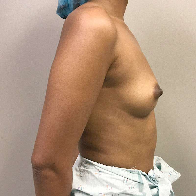 Breast Augmentation 05