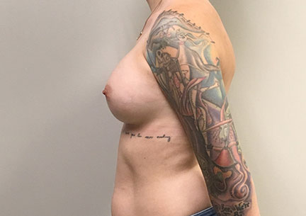 Breast Augmentation 05