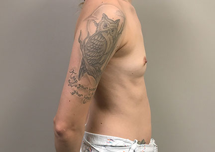 Breast Augmentation 09