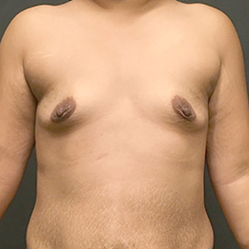 Breast Augmentation 01