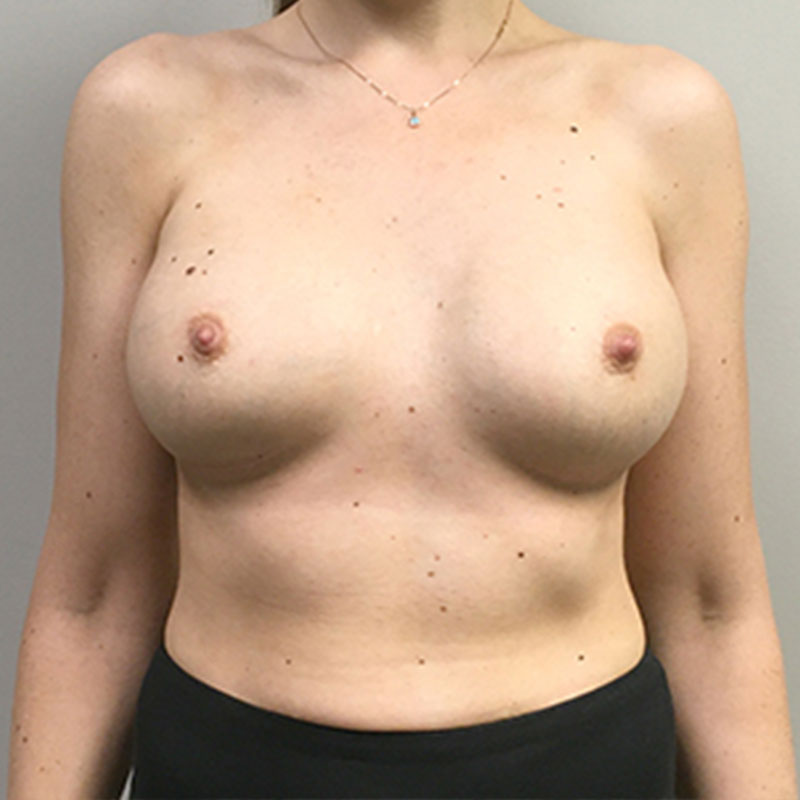 Breast Augmentation 87