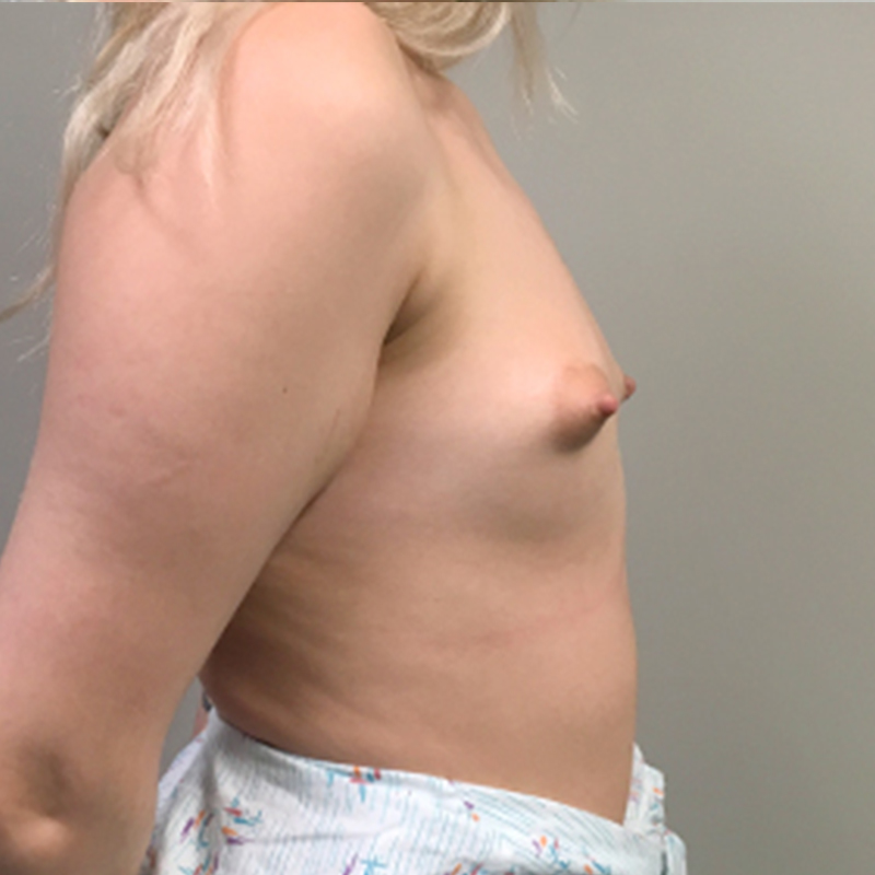 Breast Augmentation 09