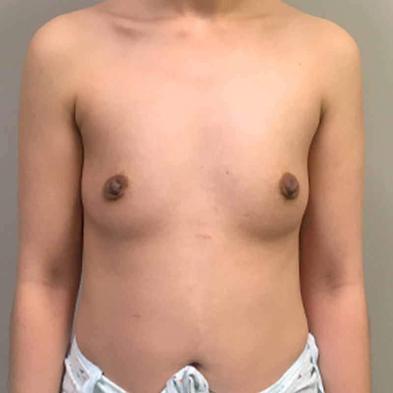 Breast Augmentation 01