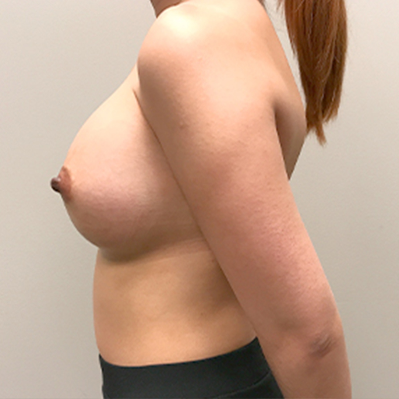 Breast Augmentation 05