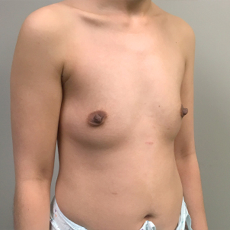 Breast Augmentation 07