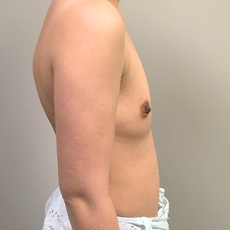 Breast Augmentation 09